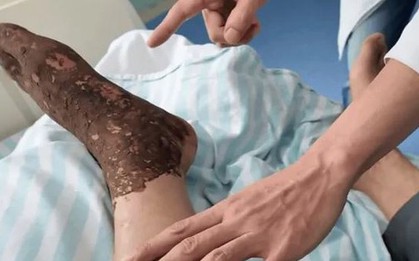 Bị rắn độc cắn khi đang cấy lúa, người đàn ông làm 1 việc khiến bác sĩ khen ngợi