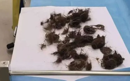 Thiếu nữ 19 tuổi hói đầu, đau bụng, bác sĩ lấy ra thứ "đáng sợ" trong dạ dày