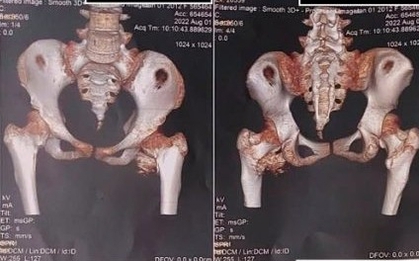 Bé gái 12 tuổi mắc "hội chứng người hóa đá" hiếm gặp, bố mẹ ngỡ ngàng khi bác sĩ nhắc tới cú ngã xe đạp 2 năm trước