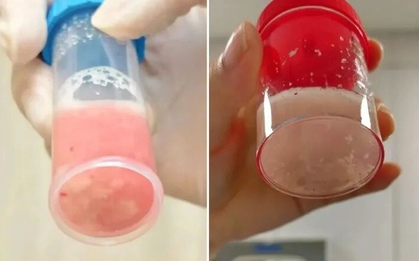 Cô bé 12 tuổi phổi trắng xóa và đông đặc sau 1 ngày bị sốt, bác sĩ cảnh báo: Đừng lúc nào cũng tưởng con cảm lạnh!