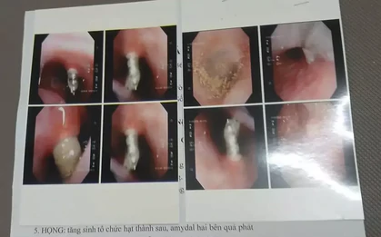 Niềng răng, vít chọc thẳng vào xoang mũi bệnh nhân, bệnh viện nói gì?