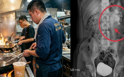 Nam đầu bếp 32 tuổi phù thận cấp tính vì 1 thói quen uống nước không ít người vẫn làm mỗi ngày
