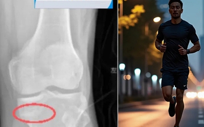 Người đàn ông gãy cả 2 chân sau 5 ngày liên tiếp chạy bộ 6km mỗi ngày, bác sĩ lên tiếng cảnh báo khẩn