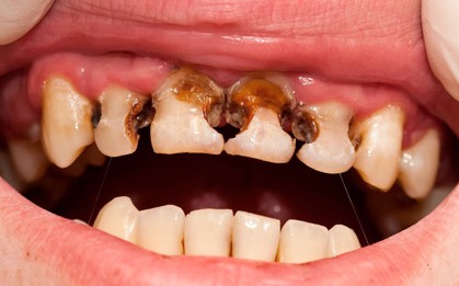 Trẻ thiếu canxi thường phát ra 5 tín hiệu: Bệnh viện Nhi đồng 2 cảnh báo đừng chủ quan