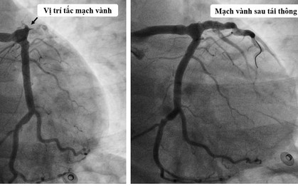 Nam thanh niên 25 tuổi suýt chết vì nhồi máu cơ tim: 10 năm trước đã làm 1 việc không ai ngờ, bác sĩ bệnh viện E lập tức cảnh báo