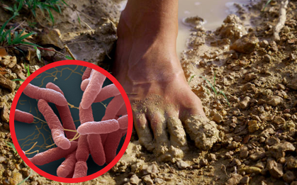 Quảng Ninh: Phát hiện ca bệnh nhiễm "vi khuẩn ăn thịt người"