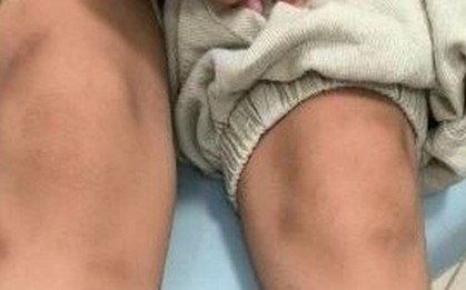 Ăn thịt nướng cuốn xà lách, bé trai 6 tuổi nổi đầy vết bầm tím "bất thường"