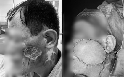 Bác sĩ Bệnh viện Bệnh Nhiệt đới Trung ương cảnh báo: Nốt nhỏ trên da có thể là ung thư, người đàn ông này đã phải cắt bỏ xương, chấp nhận biến dạng mặt