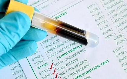 Mỡ máu từ 7,1 xuống còn 1,4 sau vài tháng: Người đàn ông 54 tuổi tiết lộ 3 thói quen bỏ càng sớm, mạch máu càng "dễ thở"