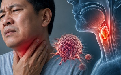 Bác sĩ cảnh báo: 6 DẤU HIỆU bất thường ở cổ họng có thể liên quan đến ung thư, nhiều người nhầm là viêm họng thông thường
