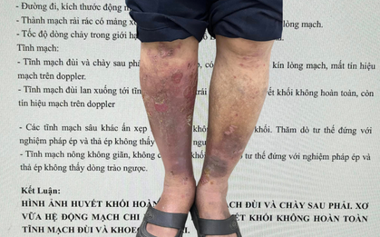 Bác sĩ chuyên ngành mạch máu xót xa khi bệnh nhân biến chứng suy giãn tĩnh mạch chi dưới, nguy cơ huyết khối, tử vong vẫn: "Tôi tưởng cái này là bình thường"