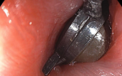 Bé 5 tuổi đau bụng dữ dội, bố mẹ sốc khi bác sĩ gắp ra thứ "đáng sợ" bên trong