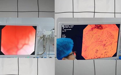 Vì sao cùng là kết quả "bình thường" nhưng nội soi đường tiêu hóa bằng máy phóng đại 520 lần đáng tin cậy hơn 135 lần?