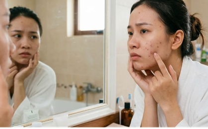 Những vitamin, khoáng chất nào tốt cho da mụn?