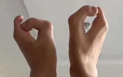 Người đàn ông có bàn chân "móng bò" và sự thật bất ngờ
