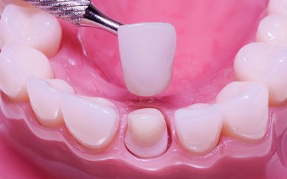 Vì sao nhiều người bọc răng sứ xong bị hôi miệng?
