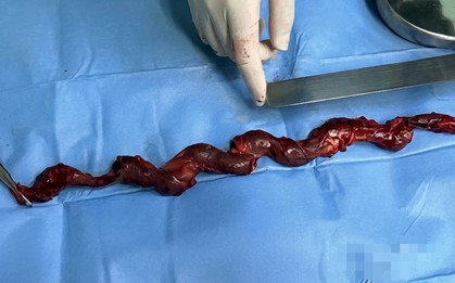 Lấy ra cục máu đông khổng lồ 40cm từ người đàn ông 10 năm vẫn cố chấp làm 1 việc