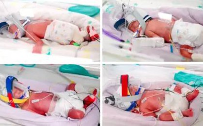 Người phụ nữ sinh 4 bé gái giống hệt nhau cùng trứng, cùng chung một bánh nhau; bác sĩ nói: "Gần như chưa từng có"