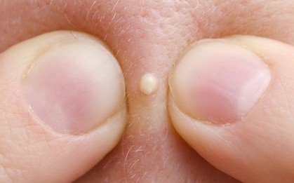 Vì sao nặn mụn hay ngoáy tai lại mang lại cảm giác sướng kỳ lạ đến thế?