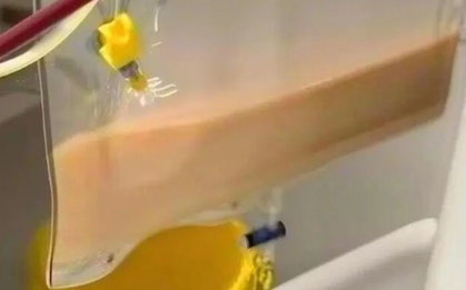 Người đàn ông 40 tuổi có "máu trắng đục như sữa", bác sĩ cảnh báo thói quen "sướng miệng, hại thân"