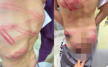 Bé trai 9 tuổi nhập viện với nhiều vết bầm tím: Lời khai của người cha sau khi thừa nhận đánh con gây phẫn nộ