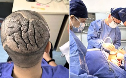 Người đàn ông 23 tuổi có da đầu dày, gấp nếp như bộ não và sự thật bất ngờ