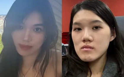 Nữ người mẫu 24 tuổi phẫu thuật thẩm mỹ từ bị móm nhẹ thành mặt lưỡi cày: Lời giải thích của bác sĩ gây phẫn nộ 
