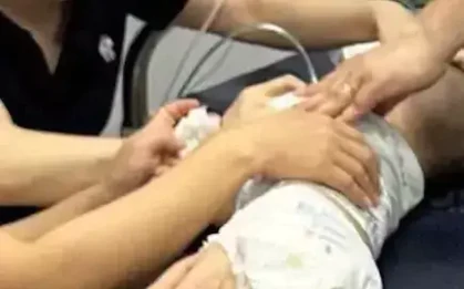 Cứu thành công bé trai hơn 1 tuổi nguy kịch vì hóc hạt chôm chôm