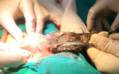 Phẫu thuật lấy búi tóc dài gần 20cm trong dạ dày bé trai 4 tuổi, do bé mắc bệnh lạ