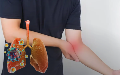 Ung thư phổi thường được chẩn đoán ở giai đoạn muộn: Nếu cảm thấy "1 chỗ sần sùi, 1 chỗ tê bì và 2 cơn đau", hãy đi khám sớm