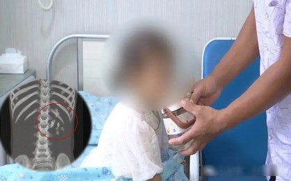 Bé gái 5 tuổi 2 năm không cao thêm, không tăng cân, đi khám bác sĩ phát hiện 1 thứ phủ đầy thận trái