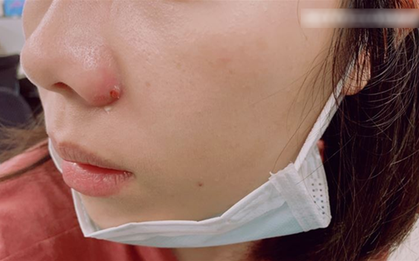 Nặn mụn quanh miệng, người phụ nữ bị sưng tấy từ môi lên tận sống mũi, bác sĩ cảnh báo: Sai lầm ở 1 điểm!