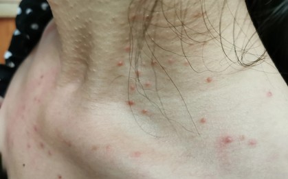 Cảnh báo: Các bệnh ung thư rất dễ "ngụy trang" dưới hình dạng của 4 loại mụn này