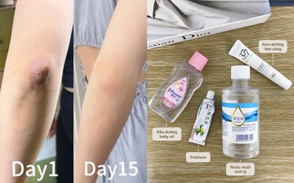 Thử “giải cứu” khuỷu tay thâm trong 1 tuần với 4 bước: Có một bước tôi khuyên không nên tùy tiện làm theo