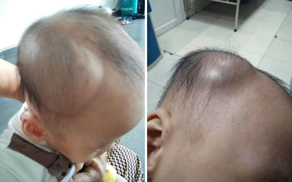 1 mẹ bỉm chia sẻ diễn biến âm thầm nhưng nguy hiểm sau cú ngã của con: Đừng chủ quan kể cả khi bé có vẻ vẫn bình thường