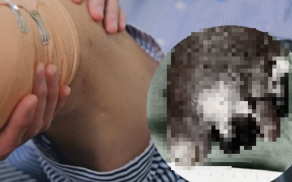 Nghe lời truyền miệng, ngâm chân nước trà xanh nóng, người đàn ông 66 tuổi phải cắt cụt chân