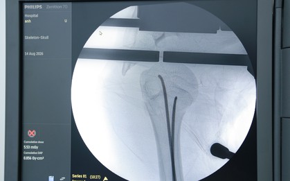 Bé gái 14 tuổi gãy xương cánh tay sau tai nạn xe đạp điện được phẫu thuật qua hai vết mổ nhỏ