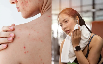 Chăm skincare kỹ nhưng lưng vẫn nổi đầy mụn? Bác sĩ da liễu chỉ ra 1 thói quen nhiều người mắc phải khiến mụn mãi không dứt