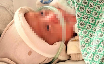 Kỳ tích cứu sống bé sinh non 750 gram, suy hô hấp, mắc bệnh phổi mạn tính