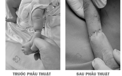 Hy hữu: Trẻ sơ sinh bị "sợi dây ẩn" thắt nghẹt cẳng chân từ trong bụng mẹ, phải phẫu thuật khi mới 12 giờ tuổi