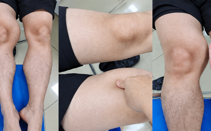 Đùi phình to như quả bóng suốt 1 năm, đi khám phát hiện ung thư hiếm gặp