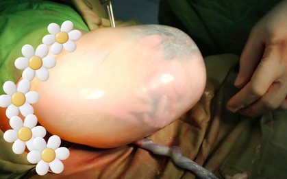 Bé gái song sinh IVF "đẻ bọc điều" đúng ngày Quốc khánh 2/9 sau 3 năm mẹ mong con