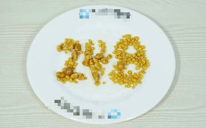 Lấy ra 248 viên sỏi từ túi mật chàng trai 26 tuổi có sở thích ăn uống "vạn người mê"