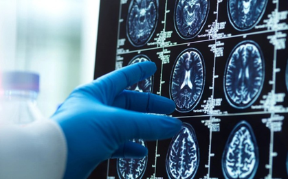 AI lần đầu hỗ trợ mổ não trực tiếp trên người: Cuộc thử nghiệm có thể thay đổi cách bác sĩ phẫu thuật