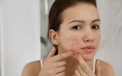 Đừng mắc sai lầm này khiến da mụn "đói" dưỡng chất