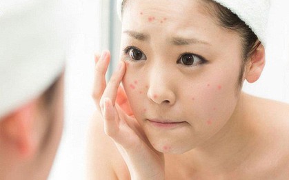 Làm đẹp đón Tết: "Team da dầu" nhất định phải biết điều này để không lo bùng mụn