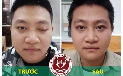 Sụp mí mắt ảnh hưởng thế nào đến thẩm mỹ khuôn mặt và cách khắc phục tại nhà