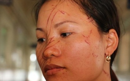 Hai mẹ con bị hàng xóm rạch mặt dã man