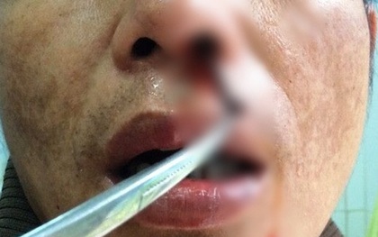 Kinh hoàng phát hiện đỉa dài hơn 5 cm trong mũi người đàn ông