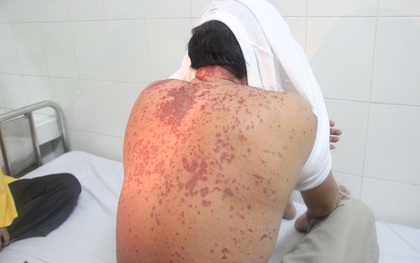 Sự thực việc một người ở Nghệ An nhập viện sau khi ăn cá biển
